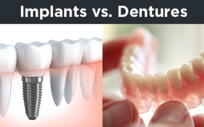 Implants v Dentures